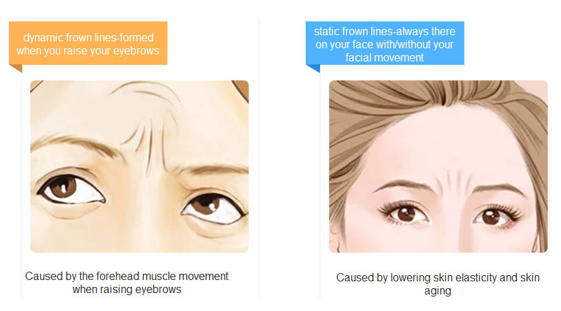 cause of frown lines