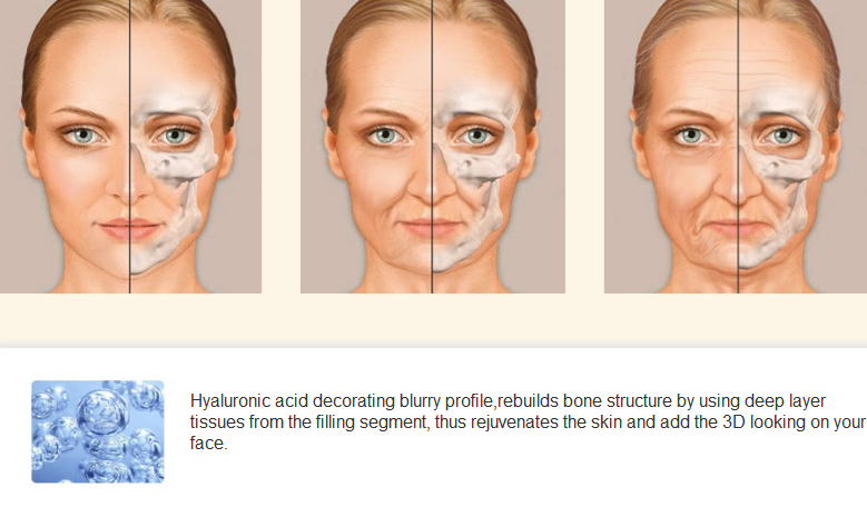 hyaluronic acid injection