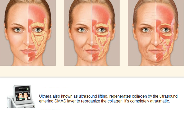 ultrasound lifting