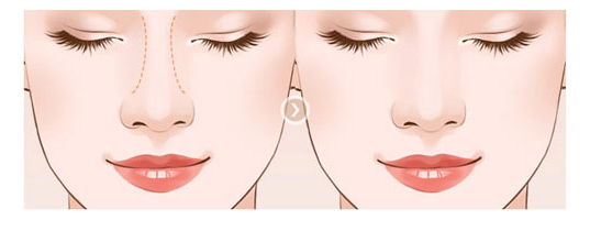 prosthesis rhinoplasty