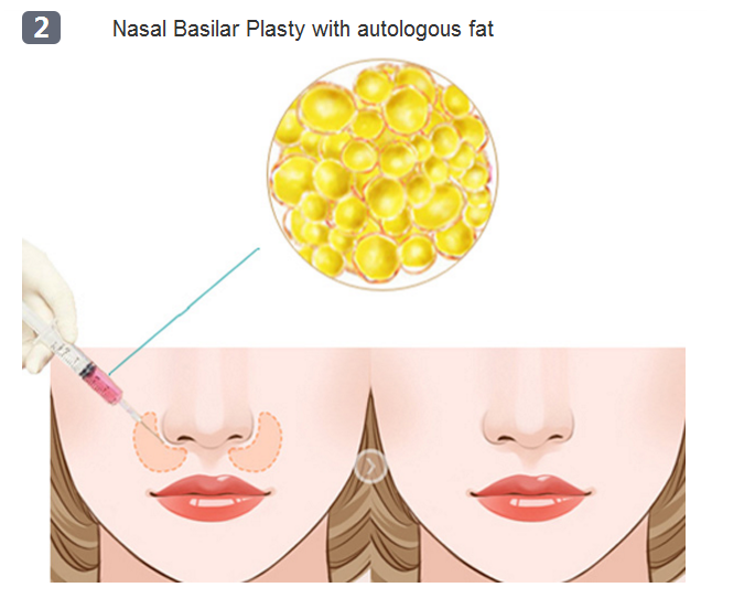 nasal base surgery method two