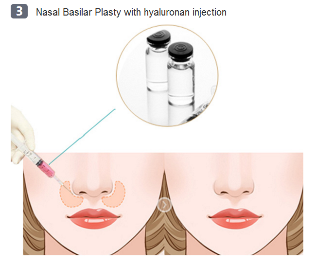 nasal base surgery method three