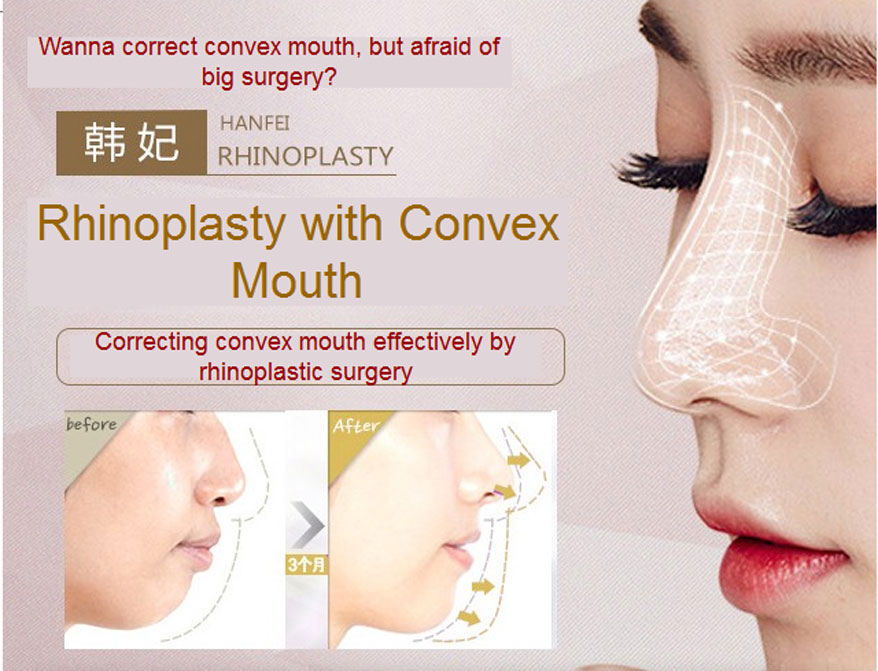 rhinoplasty with convex mouth