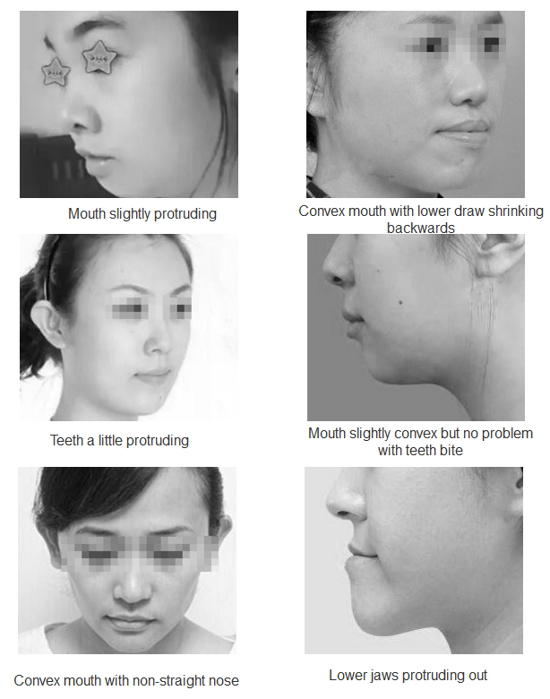 convex mouth problem