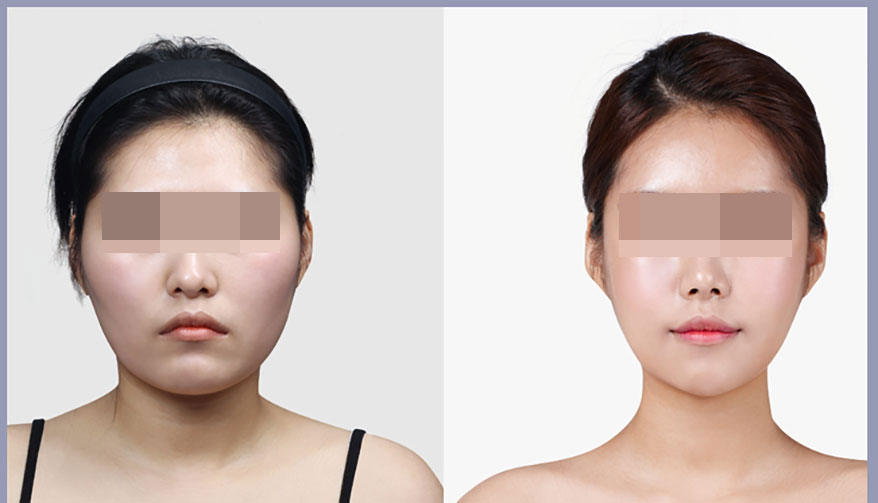 Face Plasty / Face Contouring / Double Chin_Plastic