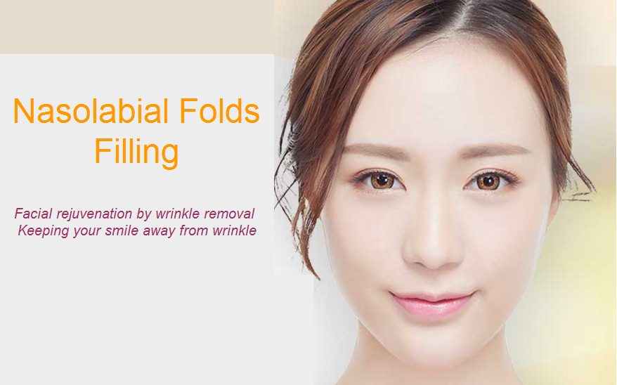 nasolabial folds filling