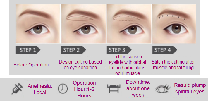 sunken eyelids revision