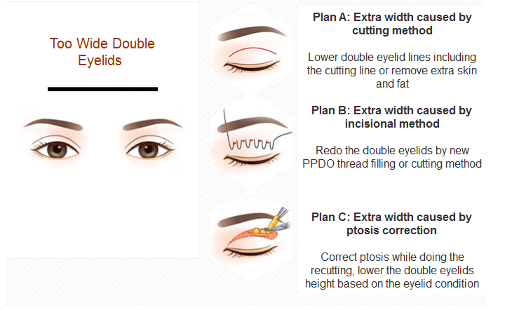 double eyelid revision