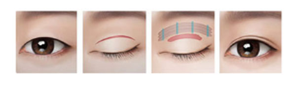 ptosis correction revision