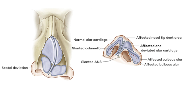 nasal deformity revision