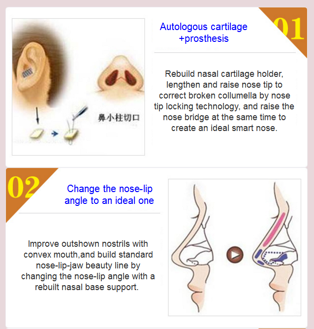 nose deformity revision