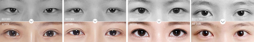 double eyelid revision