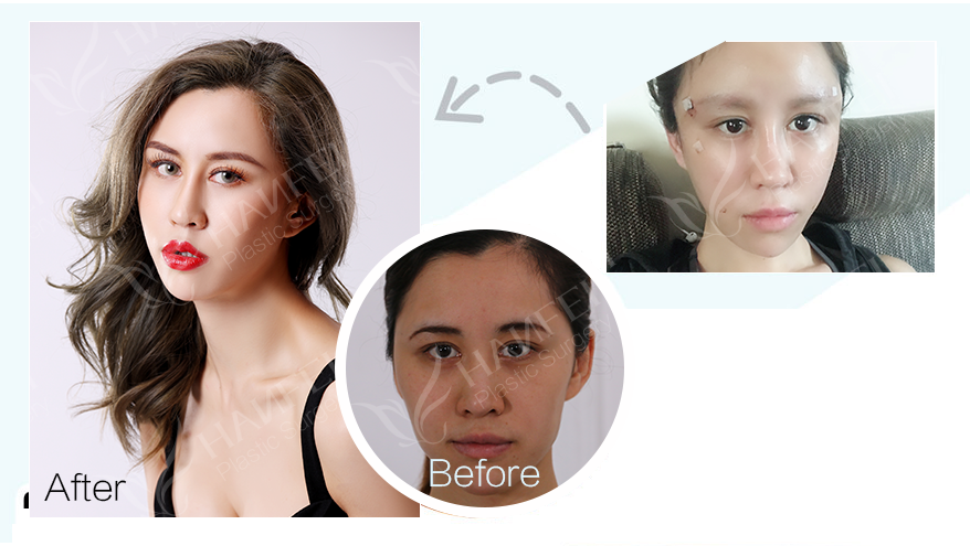 facial contouring anti-aging