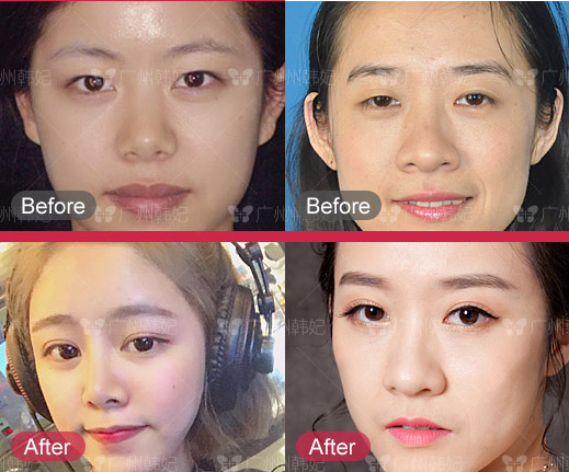 eye anti-aging