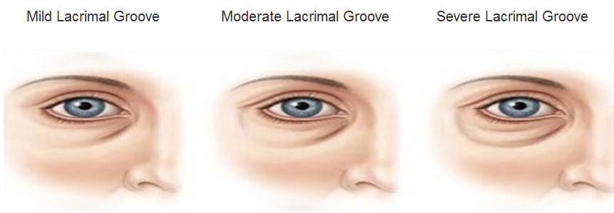 lacrimal groove