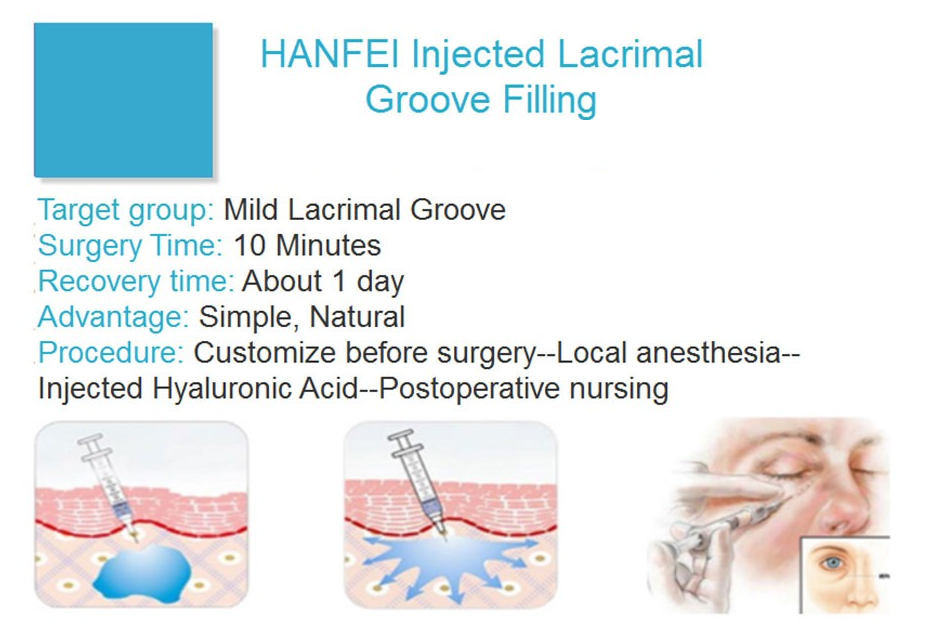 lacrimal groove filling