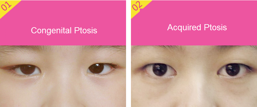 ptosis