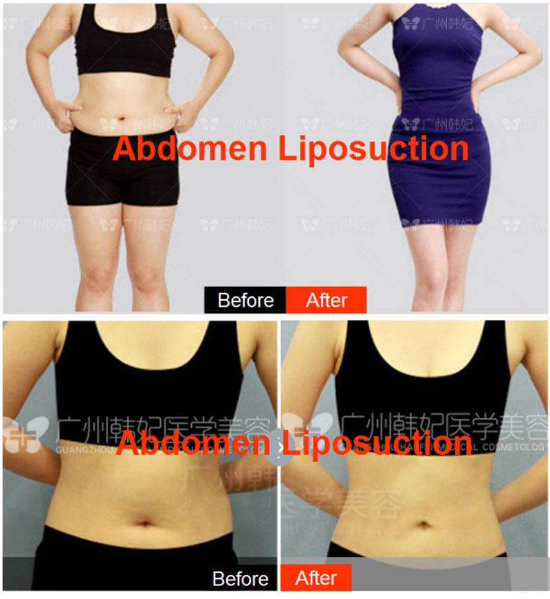 hanfei liposuction in china, face,neck,waist,abdomen,back,arms, legs cost 5000-20000rmb