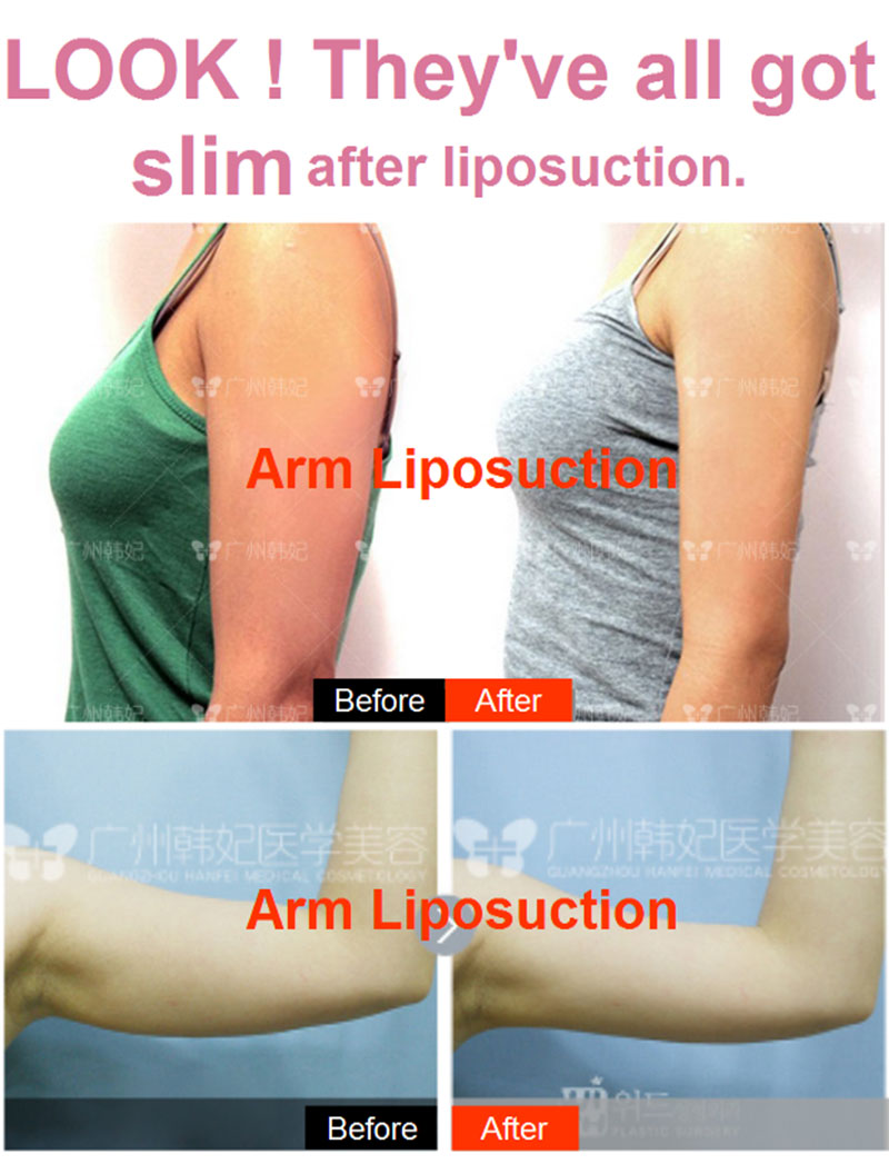 hanfei liposuction in china, face,neck,waist,abdomen,back,arms, legs cost 5000-20000rmb