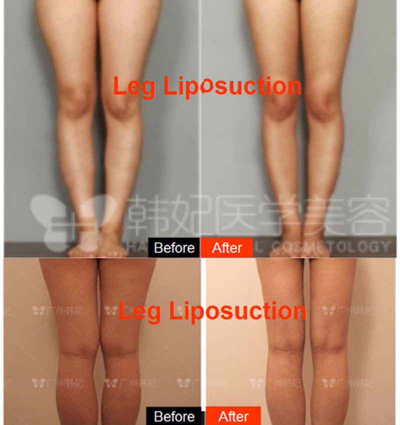 hanfei liposuction in china, face,neck,waist,abdomen,back,arms, legs cost 5000-20000rmb