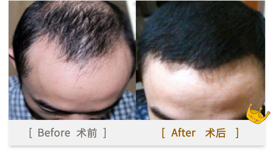 men hair plant before & after