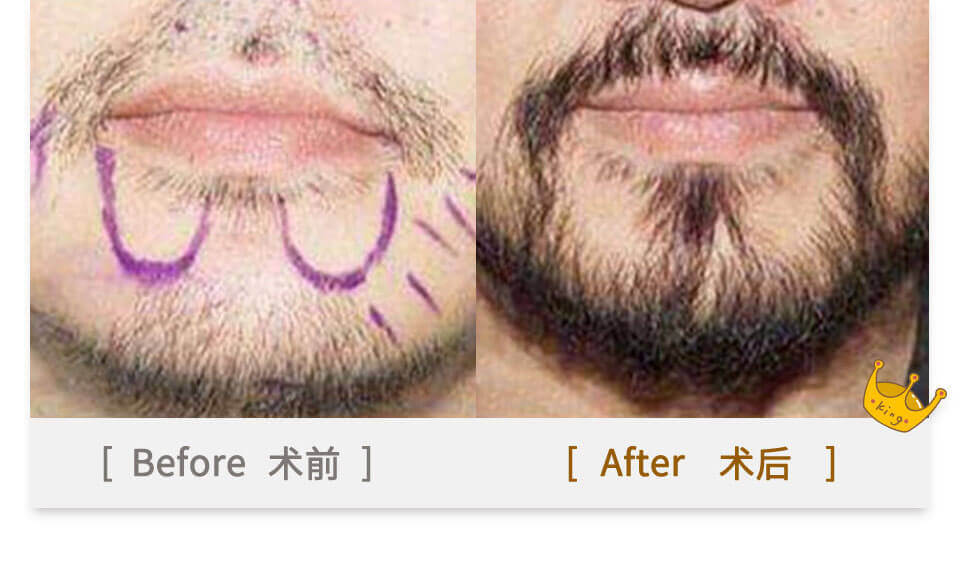 beards plant in china before and after