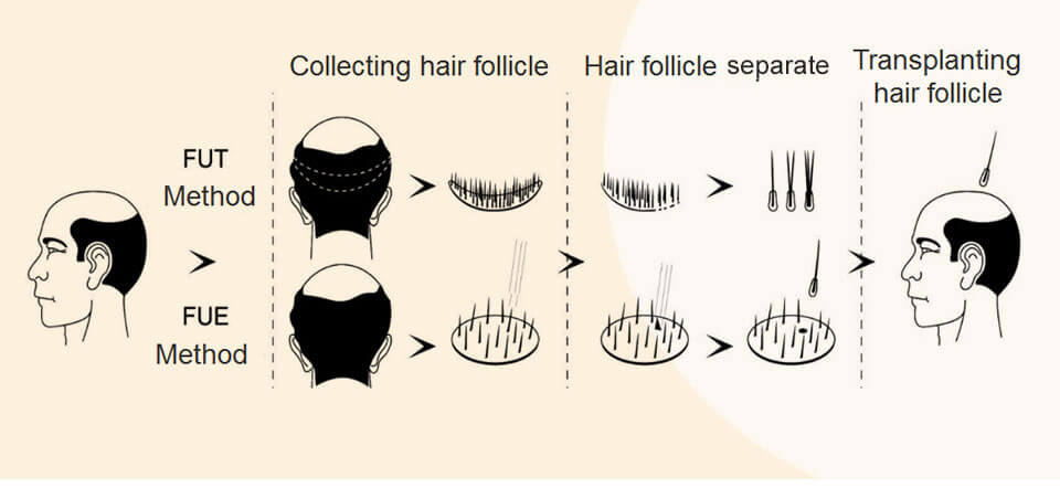 FUE, FUT hair transplant comparasion