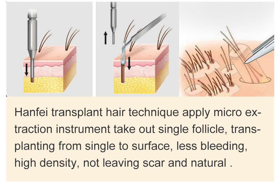 FUE hair transplant theniques