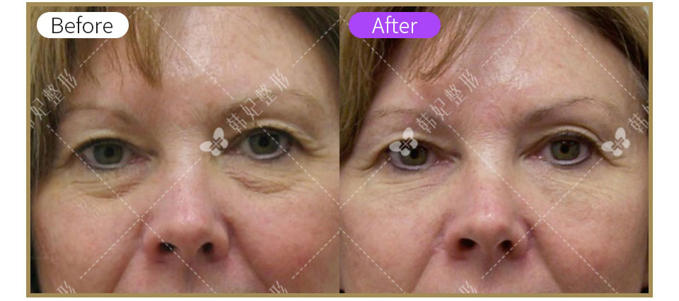 face filler fat