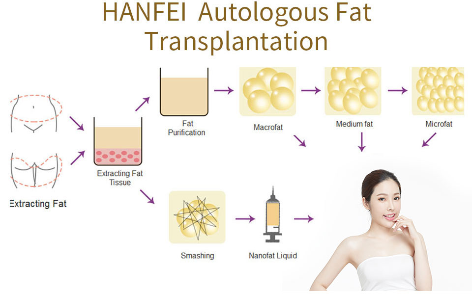 hanfei autologous fat transplantation, fat transfer
