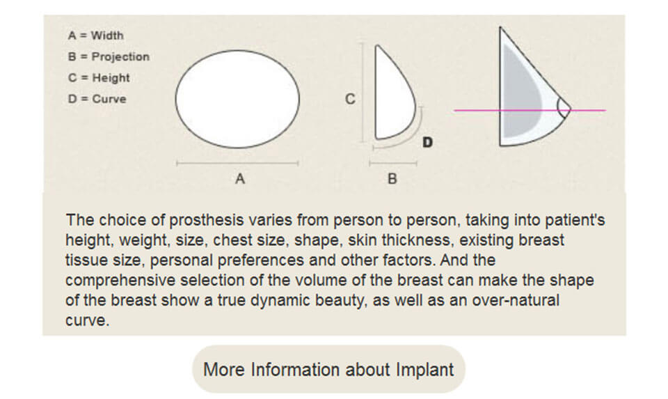 how to choose implants?
