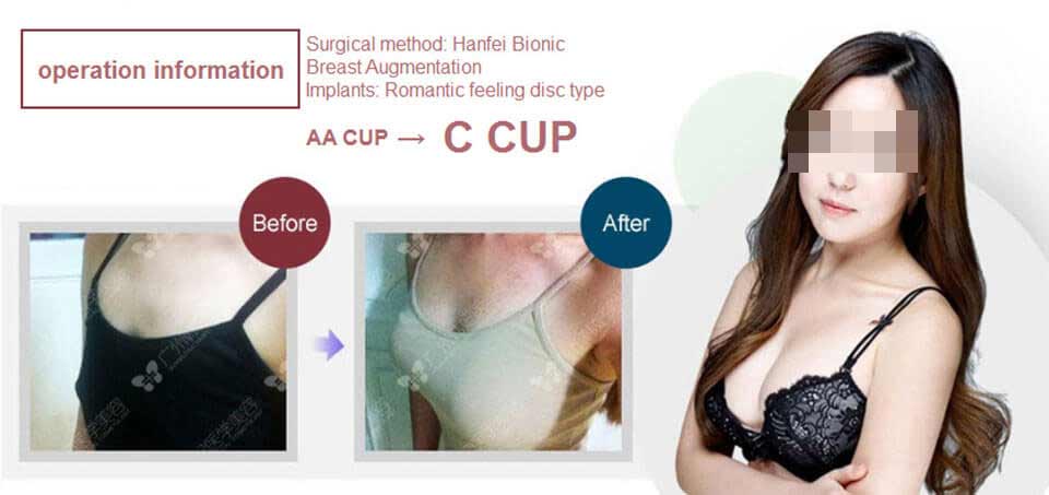 A cup to C cup breast augmentation