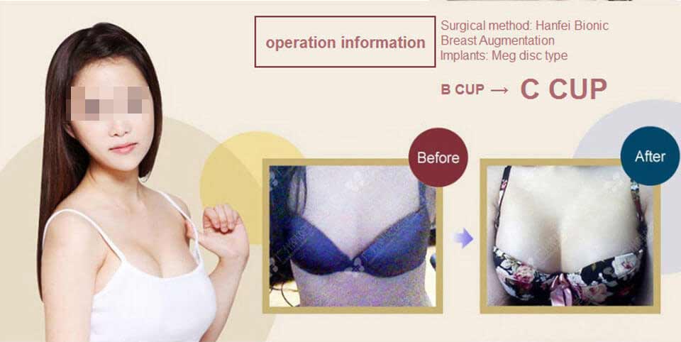 B cup to C cup breast implants augmentation