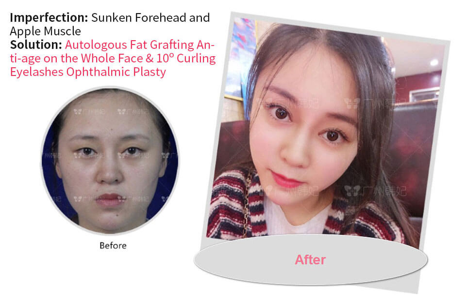 yemeng had face filling with her self fat to anti-age